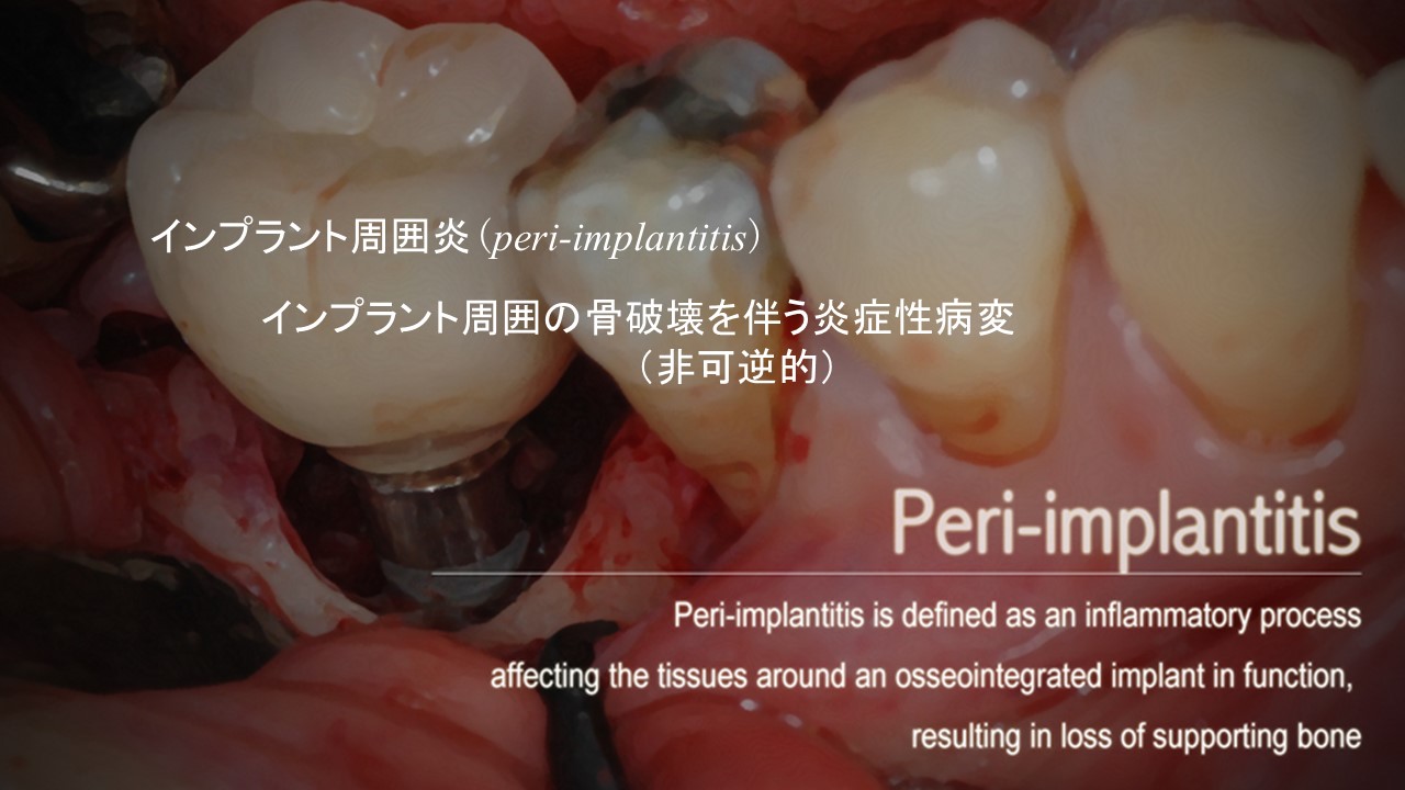 インプラント周囲疾患のすべて インプラント周囲疾患のすべて Textbook of Peri-Implant